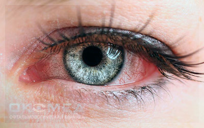 Лечение герпеса глаза