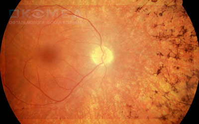 Лечение пигментного ретинита