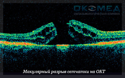 Лечение макулярного разрыва сетчатки в Москве, клиника "ОкоМед"