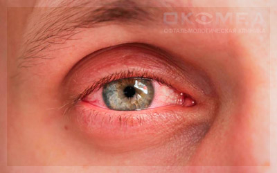 Какой вред могут причинить капли от покраснения и сухости глаз?