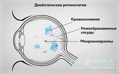 Как диабет влияет на зрение?