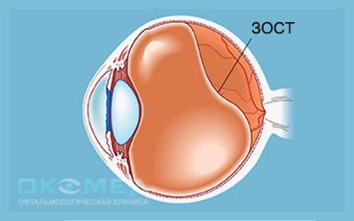 Лечение задней отслойки стекловидного тела в Москве