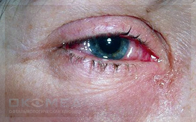 Ожоги глаз и их лечение