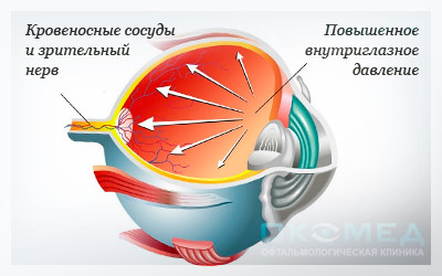 хирургия глаукомы в Москве