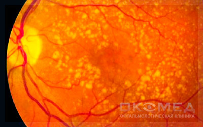 Диагностика и лечение ретинита в Москве