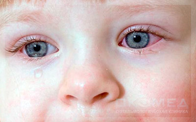 Профилактика воспалительных заболеваний глаз