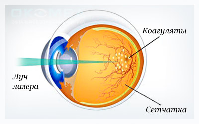 Лазерное лечение сетчатой оболочки глаза