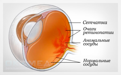 Лечение диабета глаза в Москве