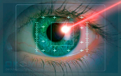 Современные методы лазерного лечения глаукомы